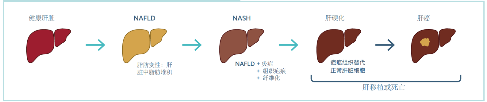 人类肝脏NAFLD/NASH发展示意图