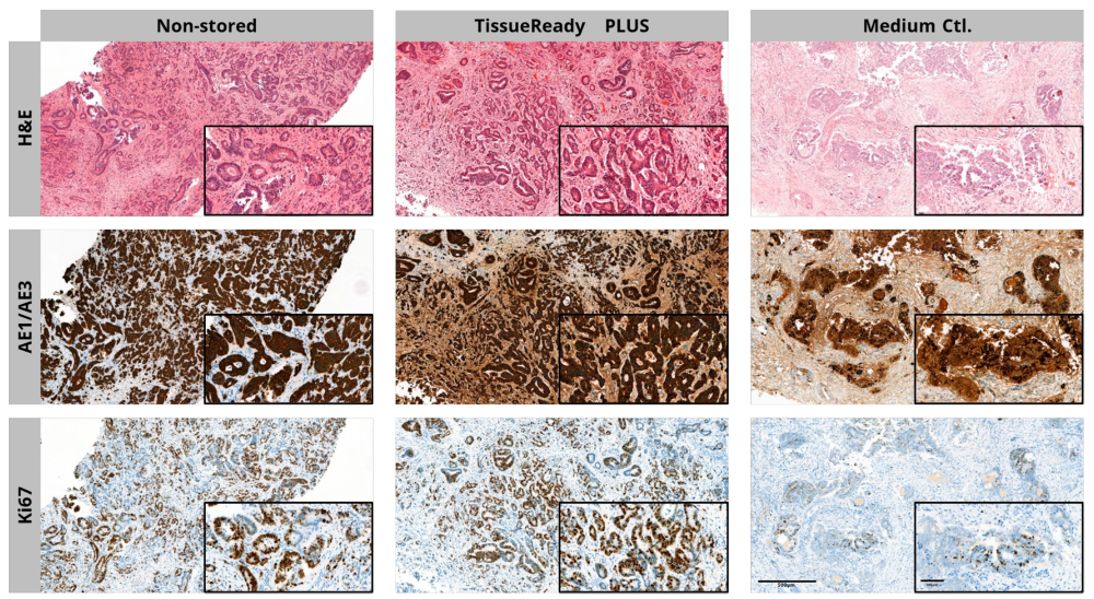 室温下采用TissueReady PLUS保存2天的肝癌组织