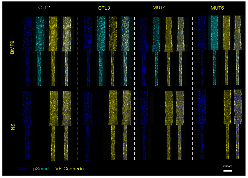对照组与携带ALK1突变的内皮集落形成细胞对BMP9的p-Smad1/5信号响应1